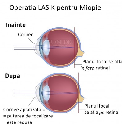 viziune după baie dacă apare hipermetropie